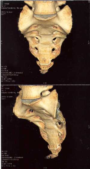 MRI dislocated coccyx